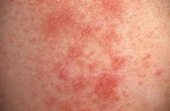 A color photograph showing an example of erythema