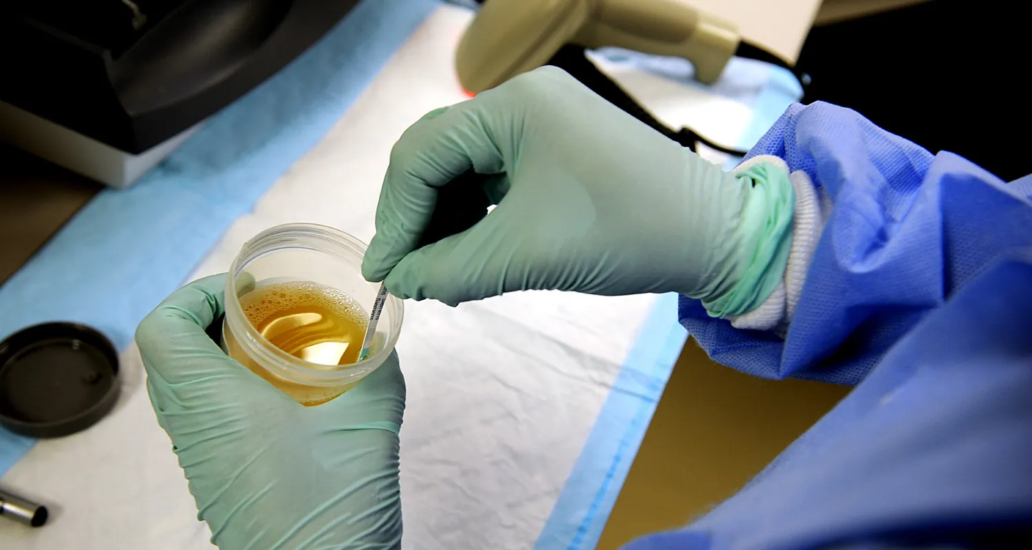 A person wearing blue protective clothing and green gloves is holding a container of yellow urine and dipping a test strip into it, indicating a medical or laboratory testing procedure.