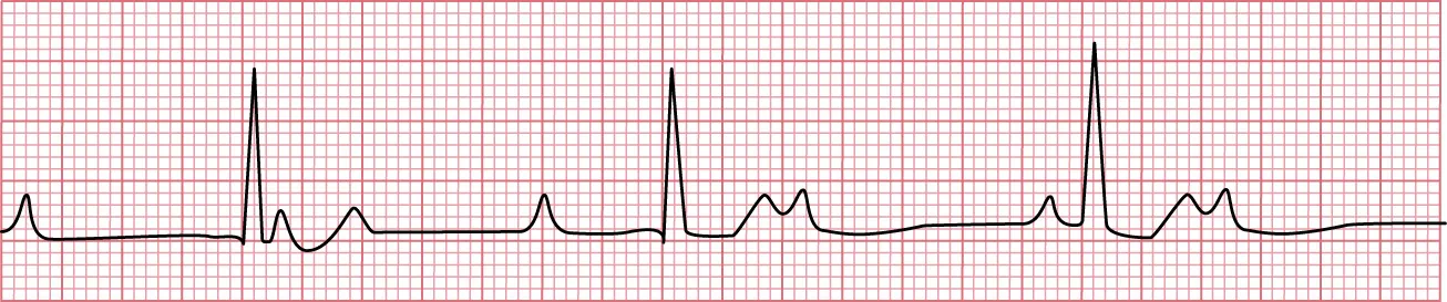 Sinus rhythm showing third degree heart block with atrial rate roughly 60 beats (six P waves), ventricular rate roughly 40 beats (4 QRS complexes), a QRS does not follow every P wave, and a wide QRS complex.