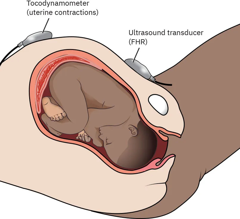 Diagram showing placements of components of external fetal monitoring system: tocodynamometer (uterine contractions) on upper uterus (fundus) and ultrasound transducer (FHR) over fetal back.