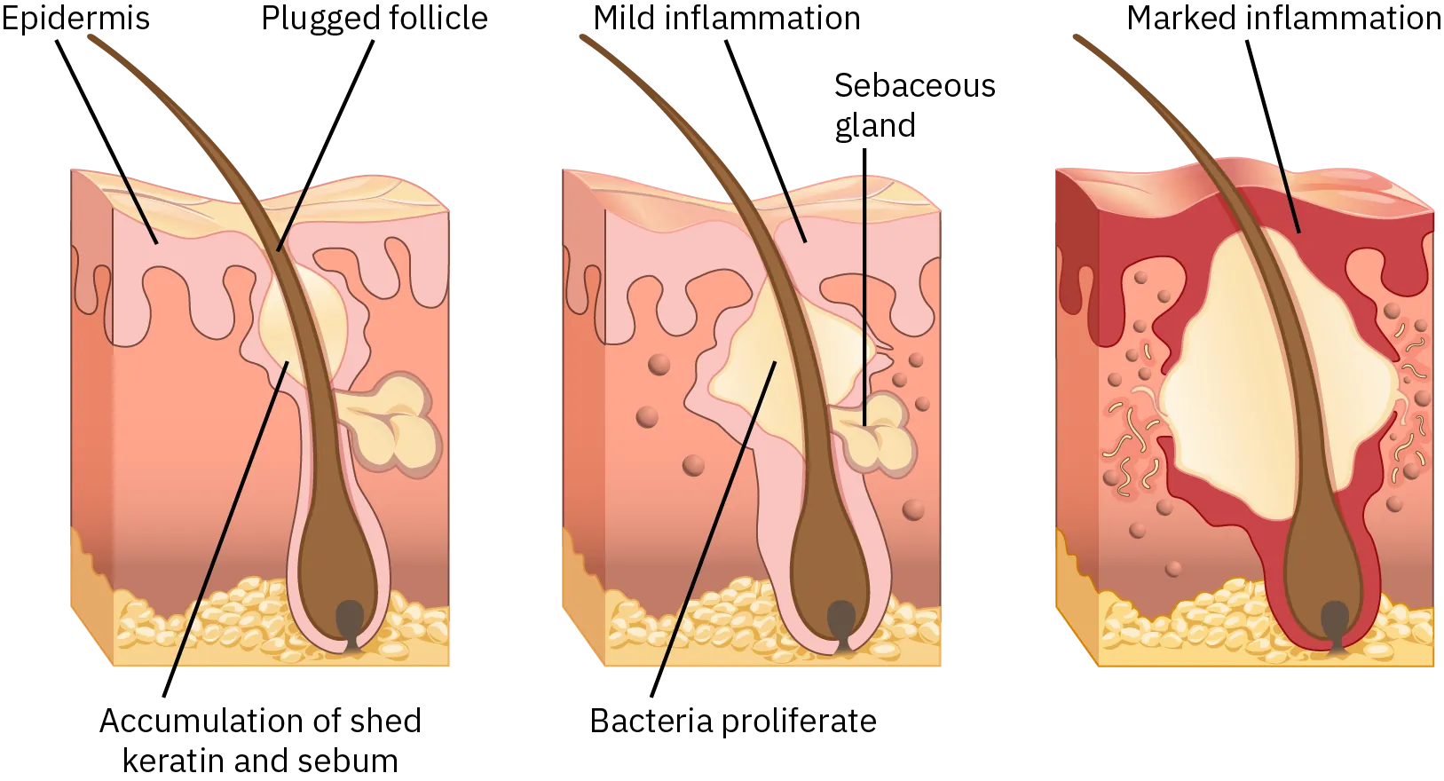 Three side-by-side drawings show how acne forms in a hair follicle. All three drawings show the hair follicle and sebaceous gland. In the first drawing, shed keratin and sebum accumulate around the hair follicle. This causes the follicle to begum plugged at the epidermis. In the second drawing, bacteria have proliferated where the shed keratin and sebum had been. This causes mild inflammation of the epidermis. In the third drawing, bacteria have continued to proliferate throughout the layers of the skin around the hair follicle. This causes marked inflammation over the epidermis, as well as down through other skin layers around the hair follicle.