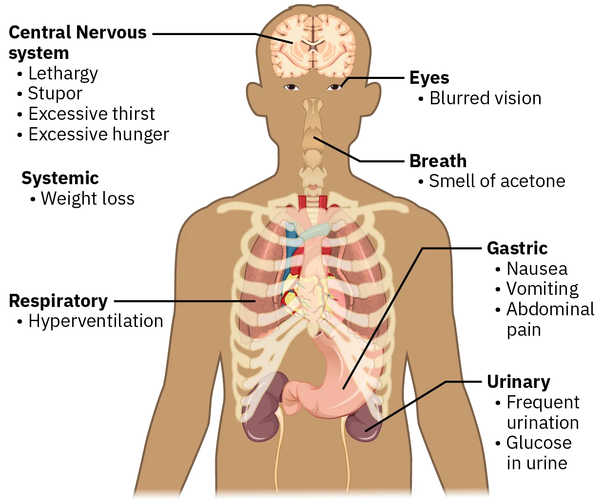 A diagram of the human body shows the different manifestations of diabetes and their associated system within the body.  Signs associated with the central nervous system include lethargy, stupor, excessive thirst, and excessive hunger. A sign associated with the respiratory system is hyperventilation. Signs associated with the urinary system are frequent urination and glucose in urine. Signs associated with the gastric system are nausea, vomiting, and abdominal pain.  In addition, vision may be blurred, breath may smell of acetone, and there may be weight loss.