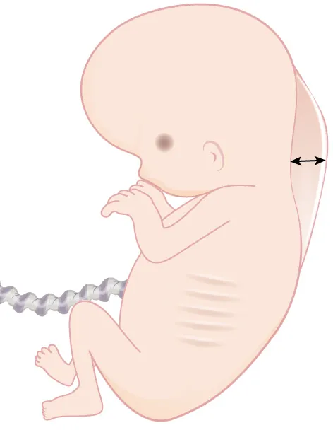 Image showing fetus with the nuchal fold indicated.