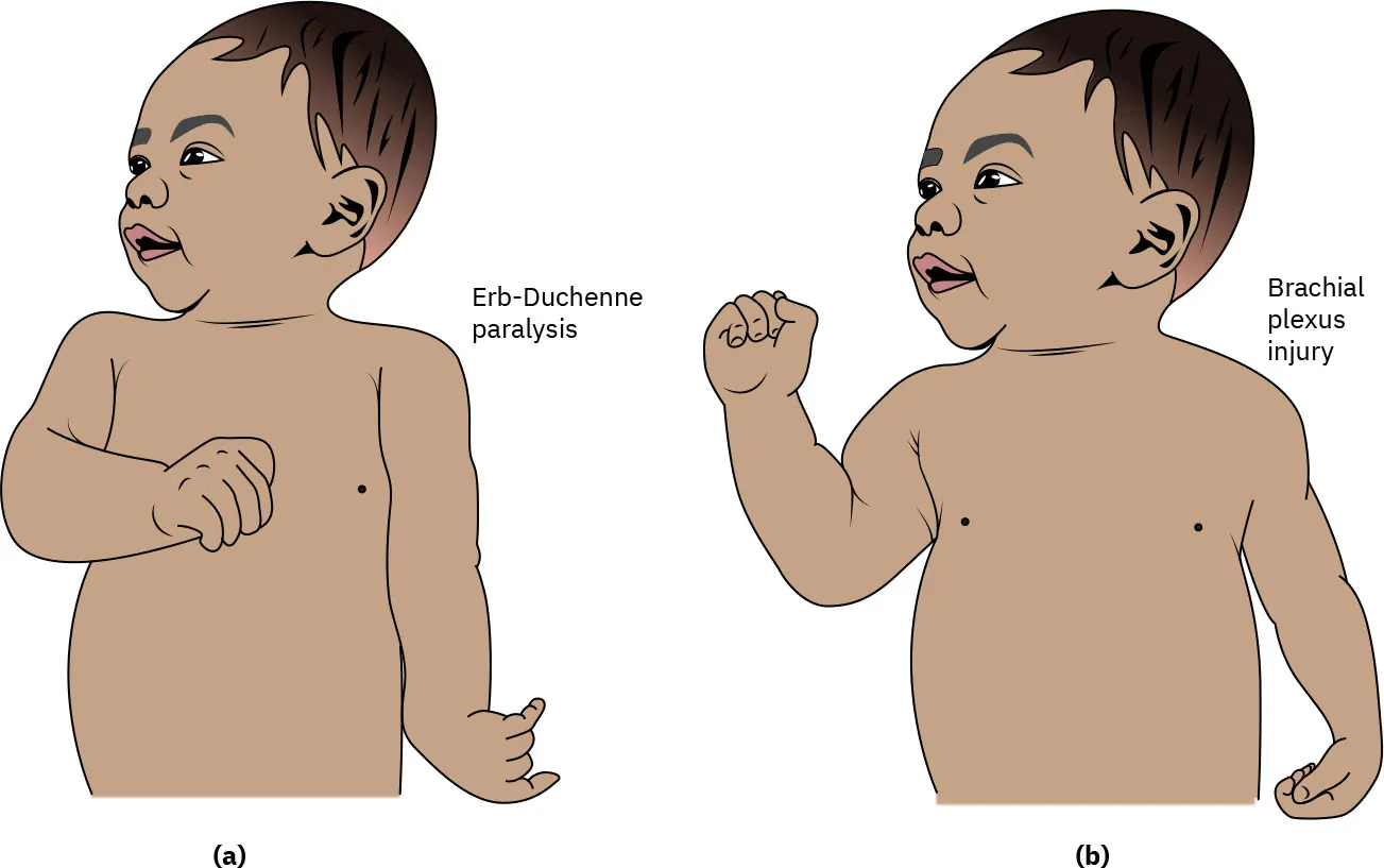 Two illustrations of an infant with birth-related nerve injuries: (a) shows Erb's palsy with the arm turned inward, and (b) shows a brachial plexus injury with a similar arm position.