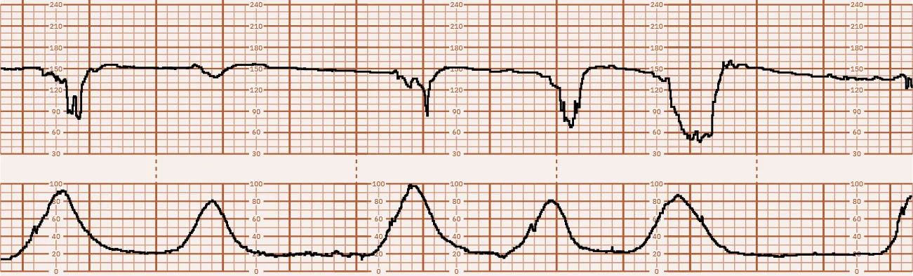 Fetal heart rate reading showing absent variability with repeat variable decelerations with uterine contractions every two to three minutes.
