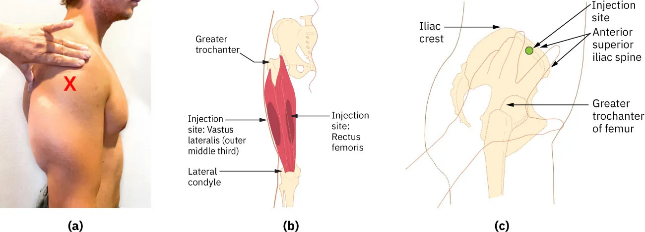 (a) Photograph shows hand locating deltoid muscle on patient. (b) Diagram of thigh labeling greater trochanter, injection site: vastus lateralis (outer middle third), injection site: rectus femoris, lateral condyle. (c) Diagram showing how to locate ventrogluteal site, labeling iliac crest, injection site, anterior superior iliac spine, greater trochanter of femur.