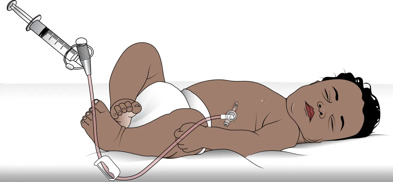 Illustration of a newborn connected to a gastric feeding tube with a syringe at the end to administer nutrition.