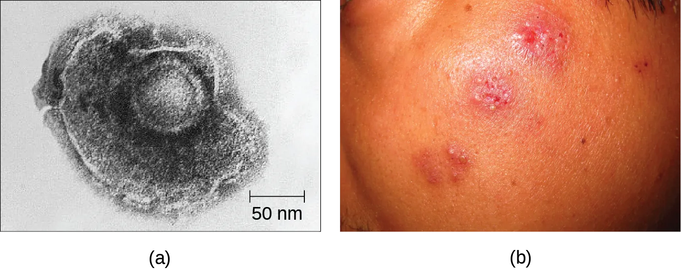 Figure a is an electron micrograph that shows a a shpere within a larger blob-shaped structure. Figure b shows raised red dots on a person’s face.