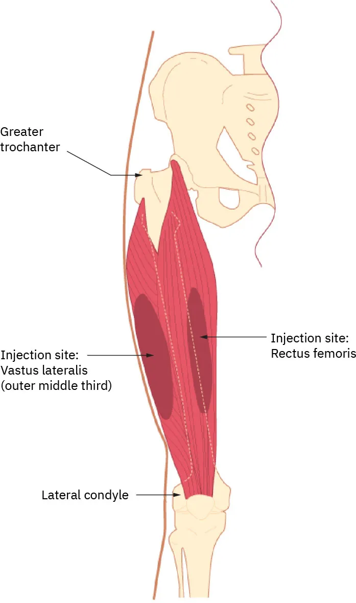 Diagram of thigh labeling greater trochanter, injection site: vastus lateralis (outer middle third), injection site: rectus femoris, lateral condyle