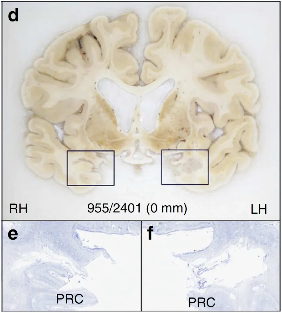 Photo of postmortem coronal brain slice from HM, showing loss of tissue where hippocampus should be.