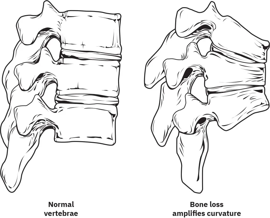 Illustrations show normal vertebrae and a vertebrae with increased curvature due to bone loss.