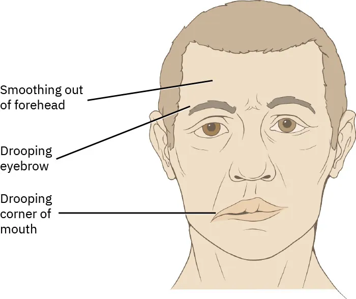 A diagram of a person’s face with Bell palsy.