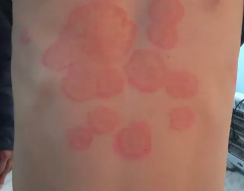 Skin with multiple reddish, circular, and irregularly shaped patches, suggesting a widespread rash or dermatological condition.