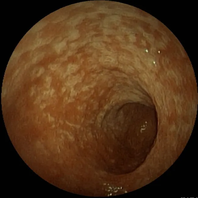 Chronic gastritis caused by H pylori infection.