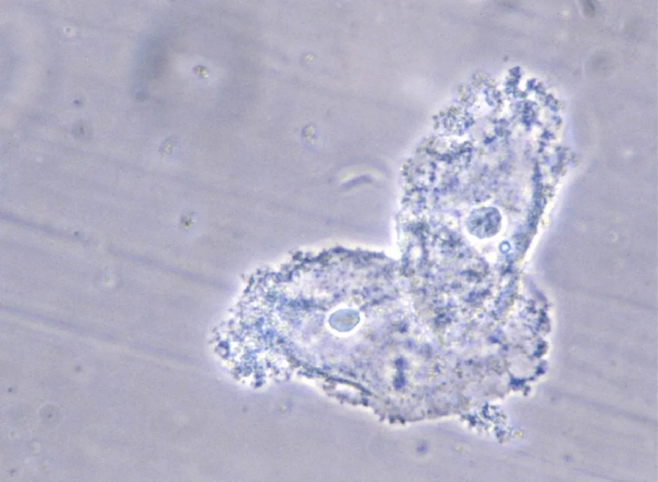 This photomicrograph shows bacteria adhering to vaginal epithelial cells known as "clue cells".