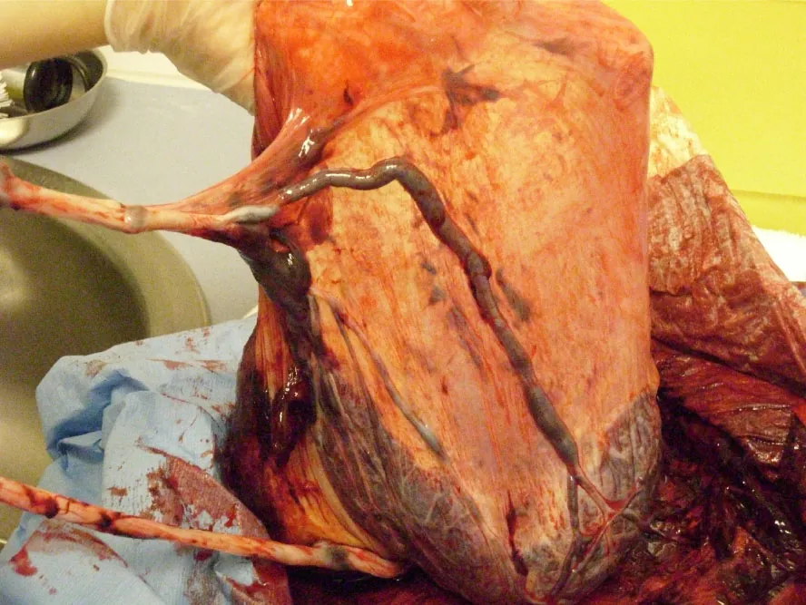 Photo of the umbilical cord attaching to the amniotic membrane.