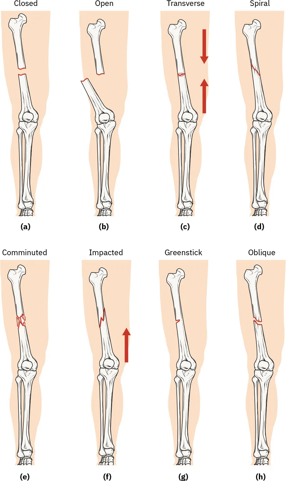 Diagrams of leg bones showing (a) closed fracture, (b) open fracture, (c) transverse fracture, (d) spiral fracture, (e) comminuted fracture, (f) impacted fracture, (g) greenstick fracture, and (h) oblique fracture