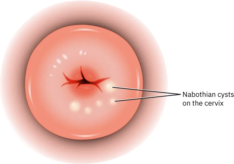 Image of Nabothian cysts (indicated by small, light colored dots surrounded by light colored rings) displaying at the bottom right of a cervix.