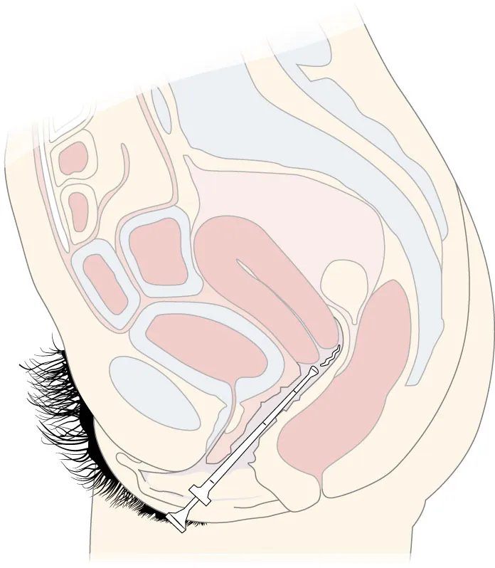 An illustration of an applicator inserted into a patient’s vagina.