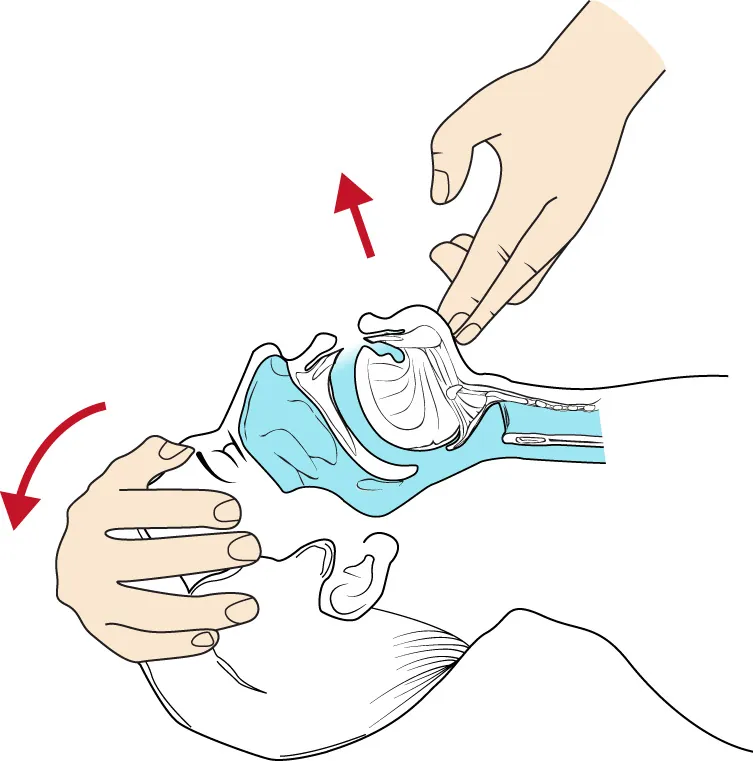 A diagram illustrating a technique for opening the airway, where one hand is placed on the person's forehead to gently tilt the head back, while the fingers of the other hand are positioned under the chin to lift it upward, ensuring the airway remains open.