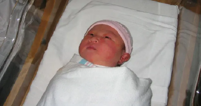 Newborn with marks from forceps delivery.