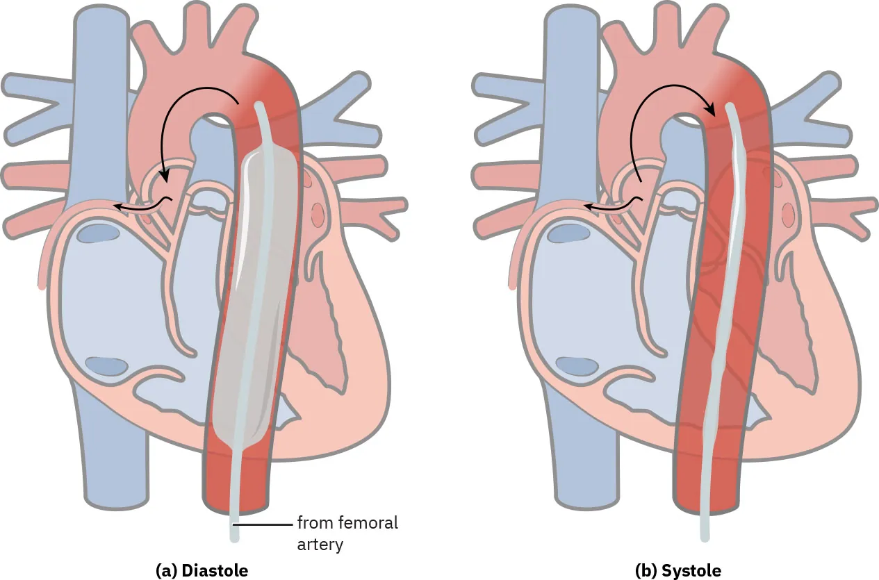 A color illustration showing an intra-aortic balloon pump both inflated during diastole and deflated during systole.