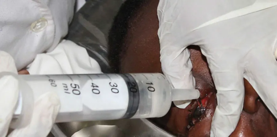 A photo of a provider using a syringe of liquid to irrigate a patient’s eye.