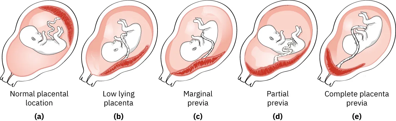 Diagram showing placenta previa: (a) normal placental location, (b) low lying placenta, (c) marginal previa, (d) partial previa, (e) complete placenta previa.