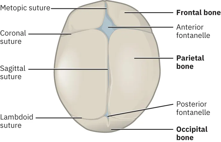 Fetal skull labeled with: metopic suture, coronal suture, sagittal suture, lambdoid suture, frontal bone, anterior fontanelle, parietal bone, posterior fontanelle, and occipital bone.