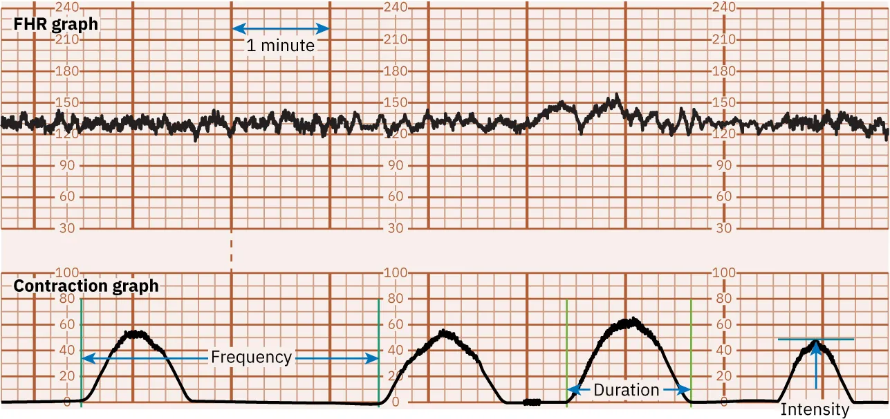 An image showing a fetal heart rate and uterine contraction monitoring graph. The top graph represents the fetal heart rate with a line oscillating around 120 beats per minute, marked by regular vertical red lines. The bottom graph shows uterine contractions with three bell-shaped curves aligning with the red lines above, and green lines indicating the start and end of contractions.