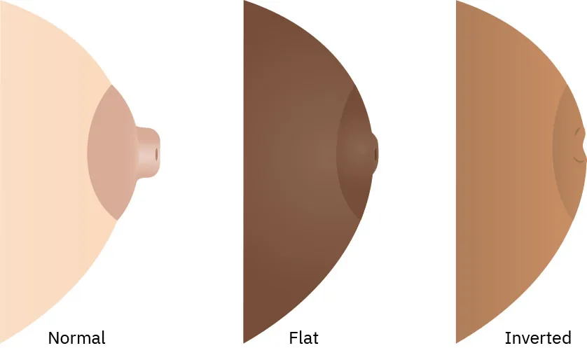 Images of nipples on a breast. The first one is of a normal nipple. The second shows the nipple flat. The last shows a concave nipple.