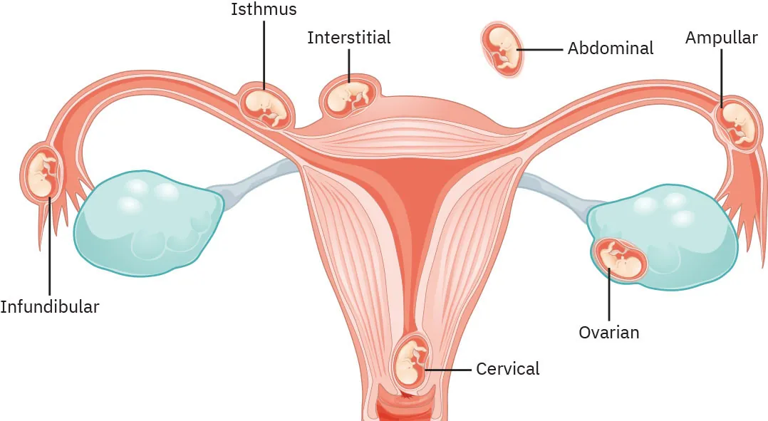 Diagram showing locations of an ectopic pregnancy: infundibular, isthmus, interstitial, abdominal, ampullar, ovarian, and cervical.