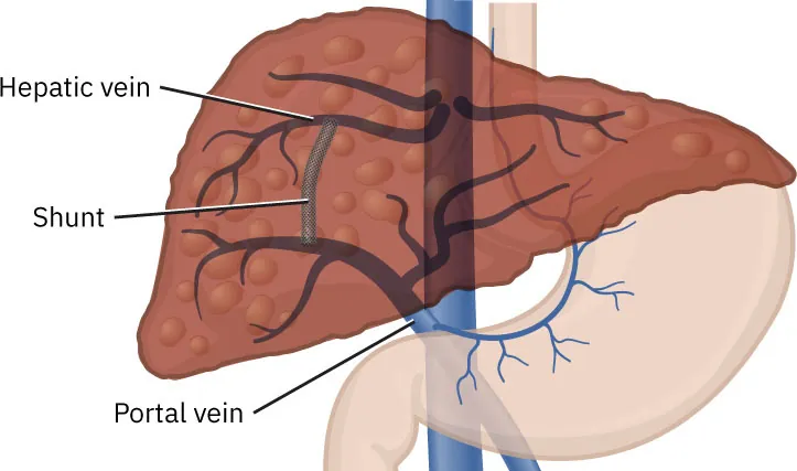 Illustration showing a TIPS procedure, labeling Hepatic vein, Shunt, and Portal vein.