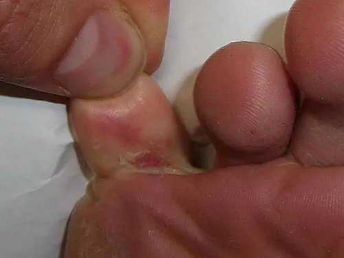 Tinea pedis