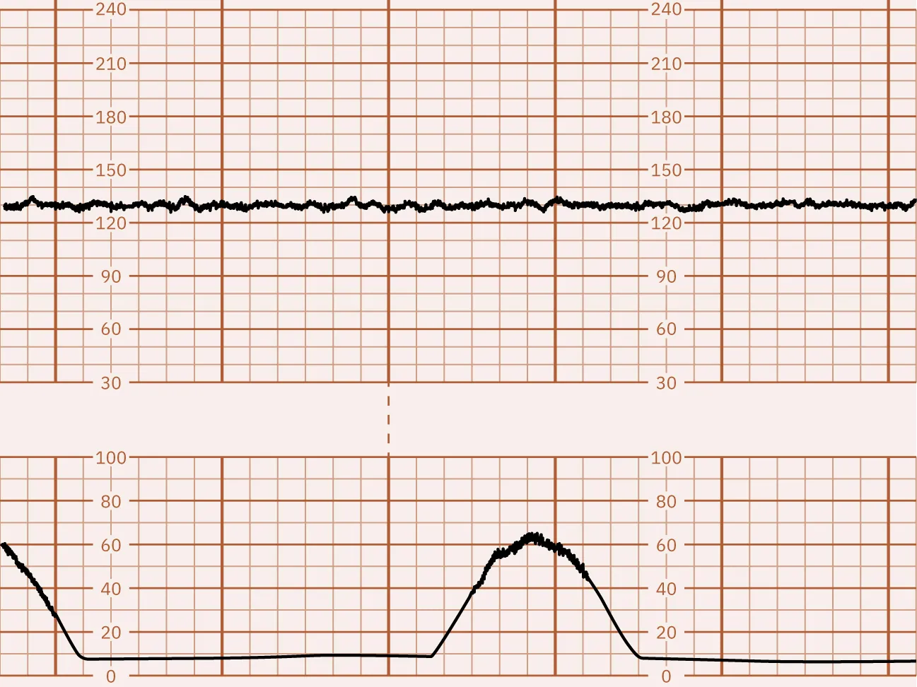 Fetal heart rate reading indicating minimal variability.