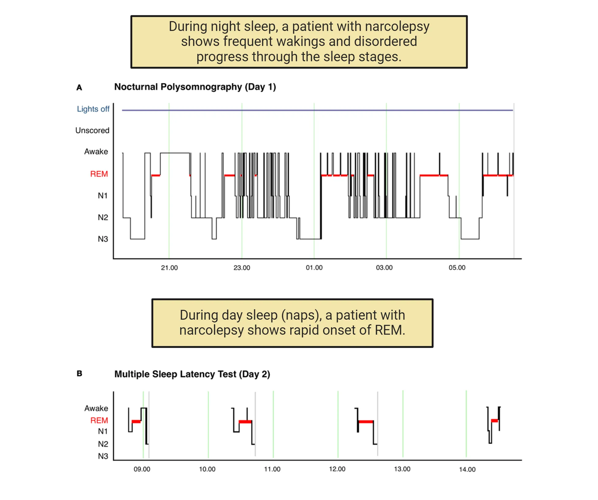 Polysomnograms of sleep stage (y-axis) versus time (x-axis). During night sleep, a patient with narcolepsy shows frequent wakings and disordered progress through the sleep stages. During day sleep (naps), a patient with narcolepsy shows rapid onset of REM.