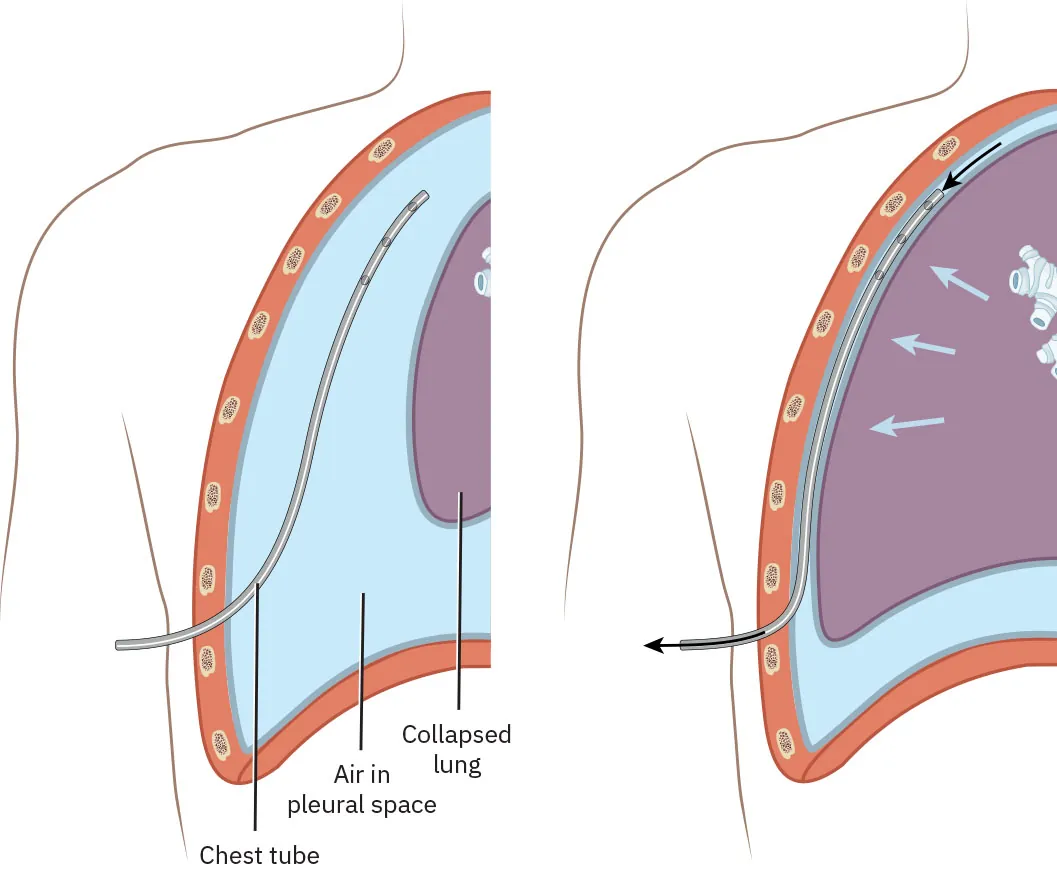 Diagram showing thoracostomy tube, labeling chest tube, air in pleural space, collapsed lung.