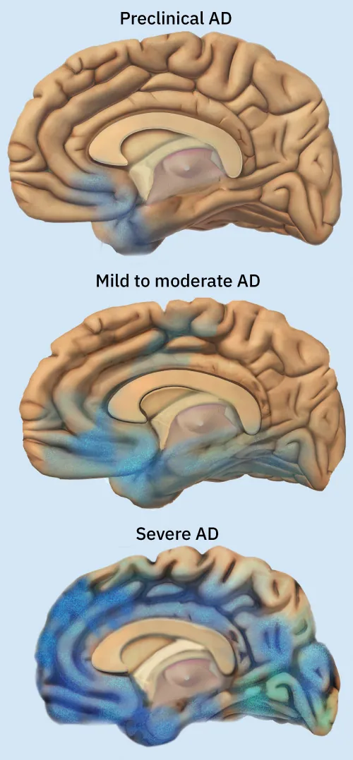 Image of brain as Alzheimer’s progresses, from Preclinical AD (mostly healthy), to Mild to moderate AD (more atrophy of areas), and then to Severe AD (brain is smaller and very atrophied).