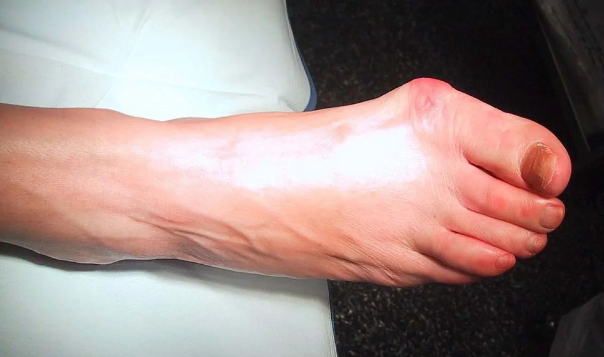 The image shows a close-up of a person's foot from the side, exhibiting significant swelling on the top due to a bunion.