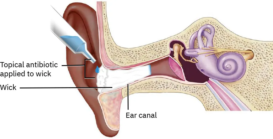 An illustration showing an ear wick in the ear canal and medicine being applied.