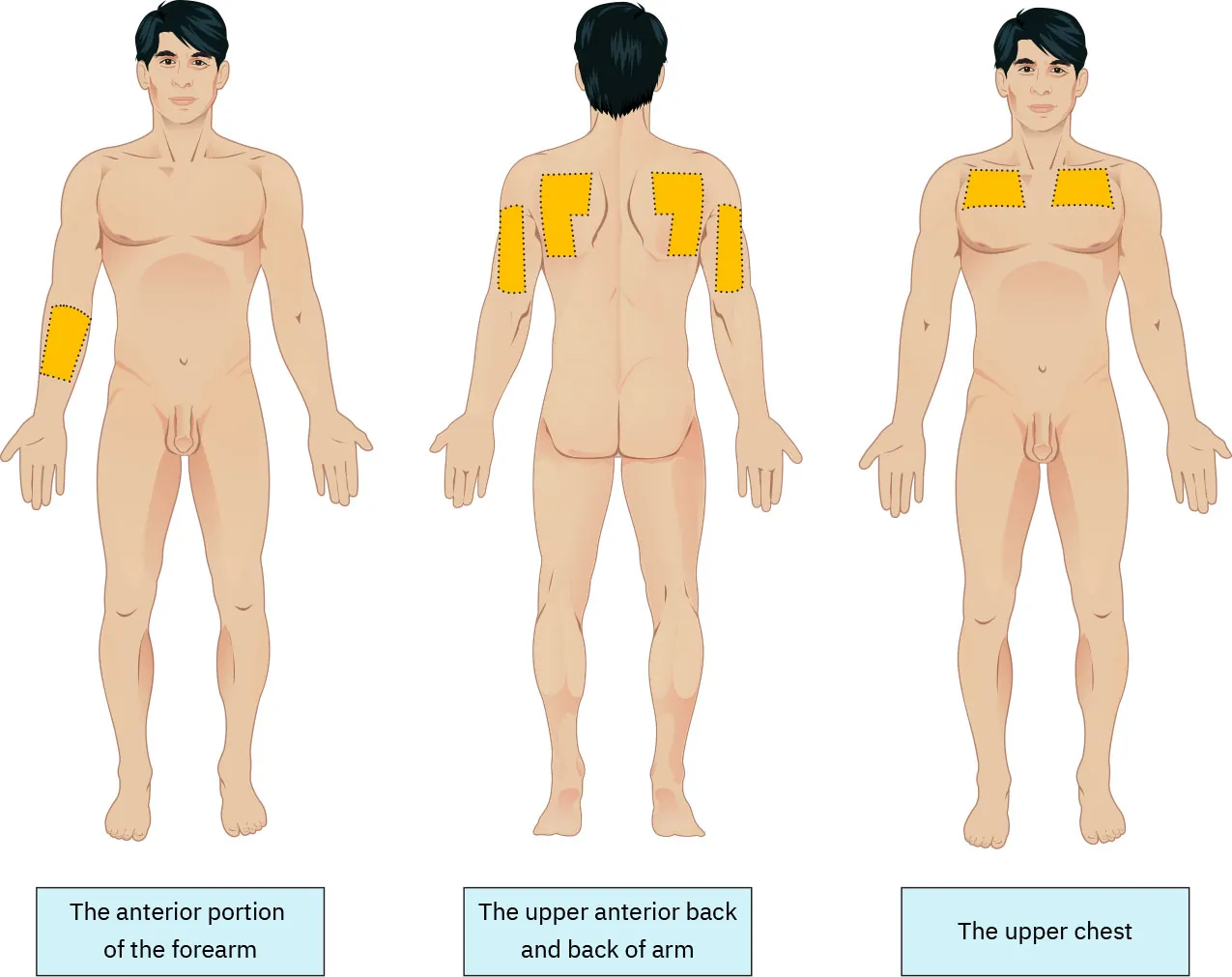 Diagram showing anatomical sites appropriate for intradermal injections: anterior portion of the forearm, upper anterior back and back of arm, upper chest
