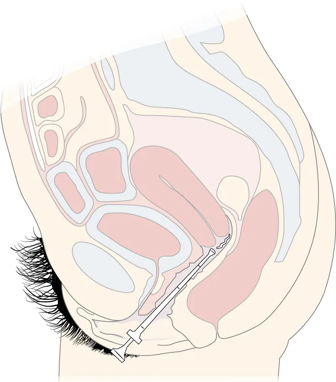 An illustration of a medication applicator inserted into a patient’s vagina.