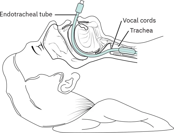 An illustration showing an endotracheal tube entering through the mouth and down the trachea past the vocal cords.