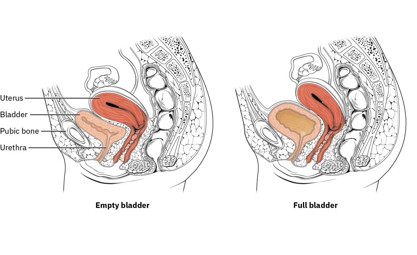 Image of (left) full bladder pushing up against uterus and pubic bone and (right) Foley catheter being inserted into empty bladder through urethra.