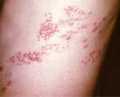 A color photograph shows a patient’s skin with a maculopapular rash due to an outbreak of shingles caused by the varicella zoster virus