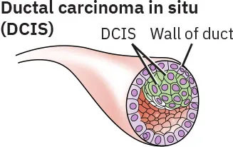 A breast duct with ductal carcinoma in situ (DCIS).