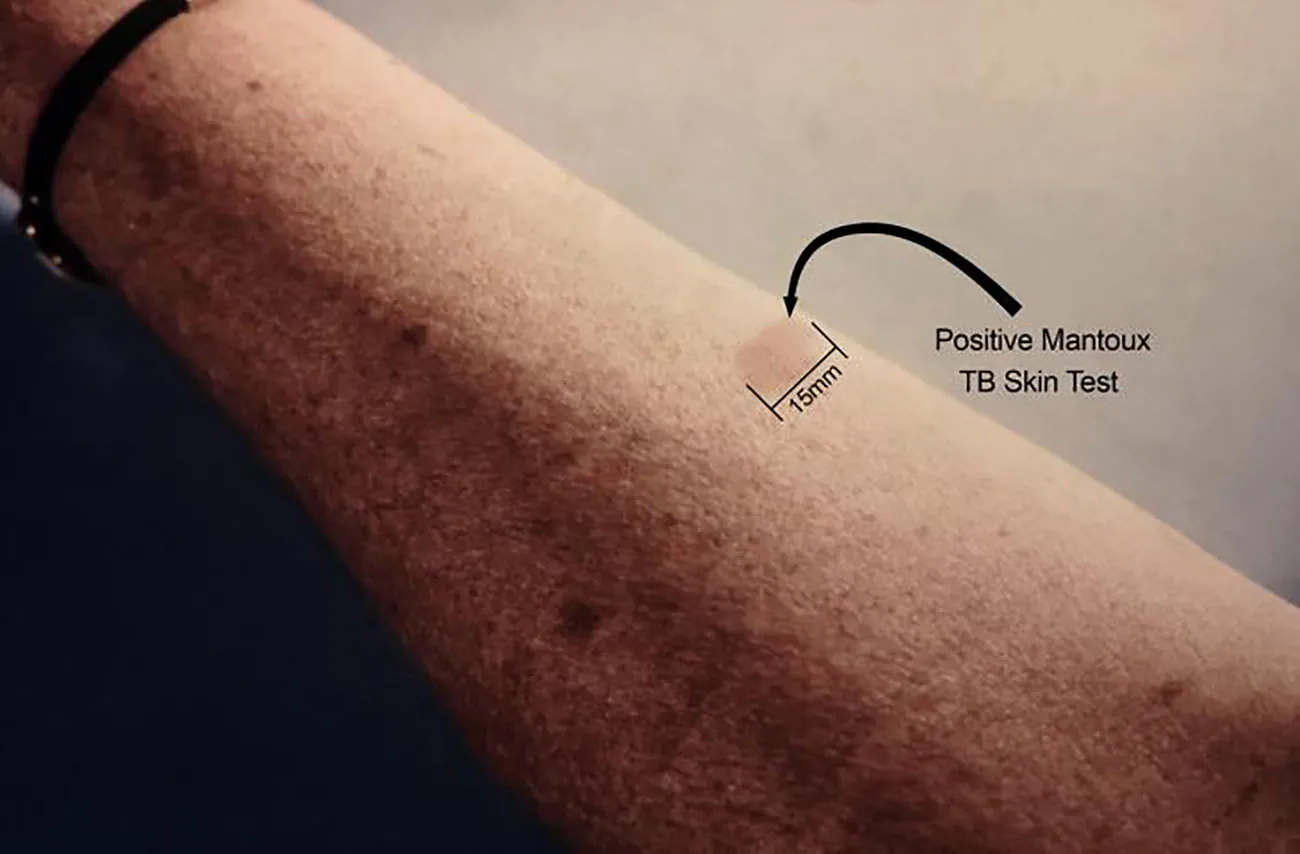 A photograph shows a positive Mantoux TB Skin Test with 15 mm label.