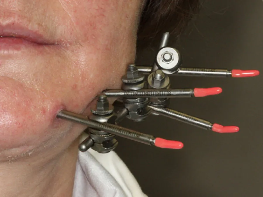 A photograph shows an external fixation on a patient’s jaw.
