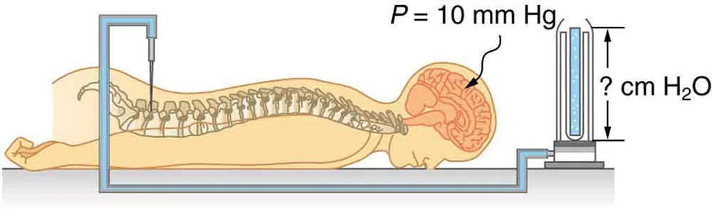 Diagram of a person lying face-down on a table hooked up to a medical apparatus. A needle attached to a tube is inserted between the patient's vertebrae in the lower back area. The tube, which appears to be filled with fluid, is connected to an upright tube containing an unknown amount of water. The height of the water in the tube is labeled question-mark centimeters H 2 O. A label pointing to the patient's head reads P equals ten millimeters H g.