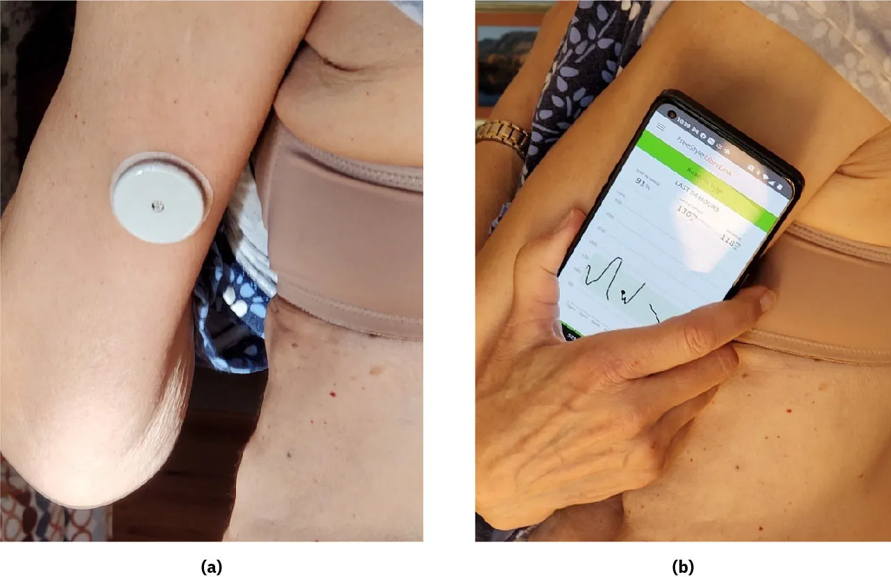 Photo of (a) wearable glucose monitor on an individual’s arm and (b) a mobile phone application displaying glucose information next to wearable monitor.